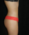 Liposuction case #4750