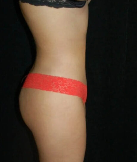 Liposuction case #4750
