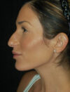 Facial Fat Grafting case #4588