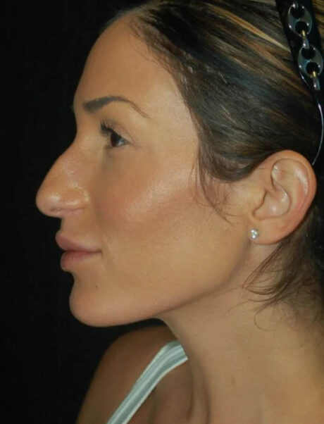 Facial Fat Grafting case #4588