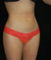 Liposuction case #4750