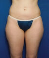 Liposuction case #4757