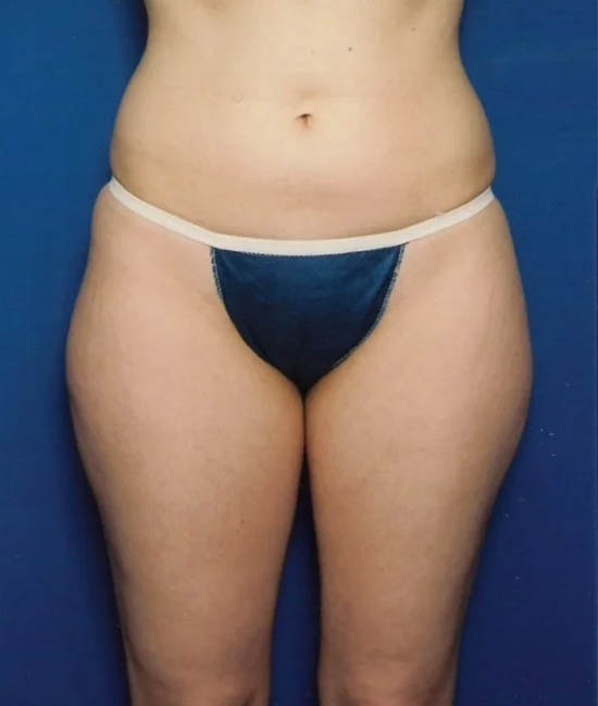 Liposuction case #4757