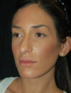 Facial Fat Grafting case #4588