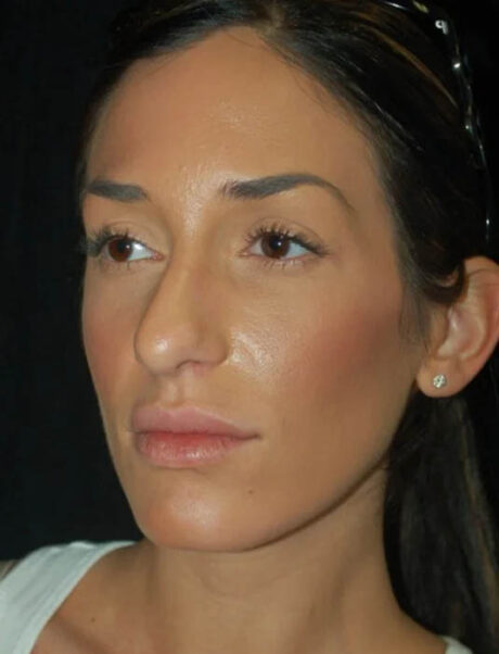 Facial Fat Grafting case #4588