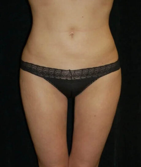 Liposuction case #4757