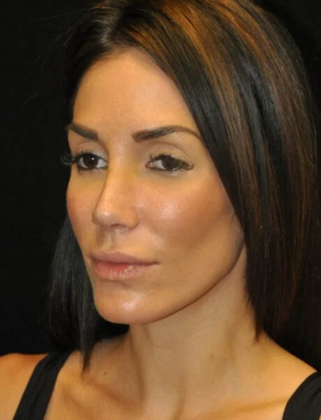 Facial Fat Grafting case #4588