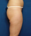 Liposuction case #4757