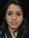 Facial Fat Grafting case #4593