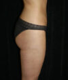 Liposuction case #4757