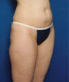Liposuction case #4757
