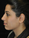 Facial Fat Grafting case #4593