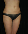 Liposuction case #4757