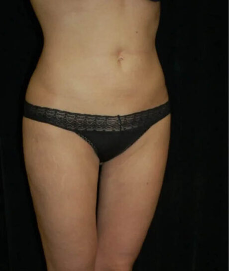 Liposuction case #4757