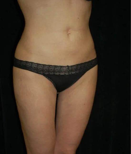 Liposuction case #4757