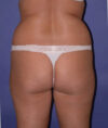 Liposuction case #4764