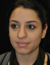 Facial Fat Grafting case #4593