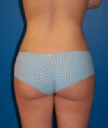 Liposuction case #4764