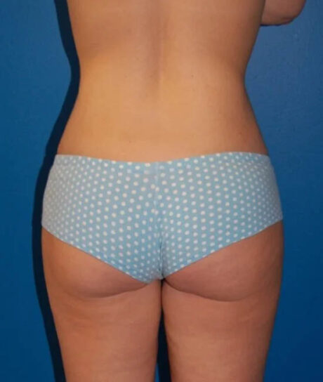 Liposuction case #4764