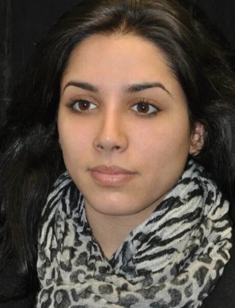 Facial Fat Grafting case #4593
