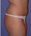Liposuction case #4764