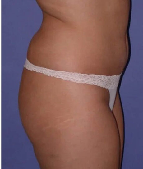 Liposuction case #4764