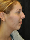 Facial Fat Grafting case #4600