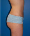 Liposuction case #4764