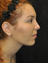 Facial Fat Grafting case #4600