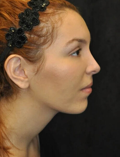 Facial Fat Grafting case #4600