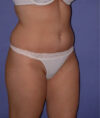 Liposuction case #4764