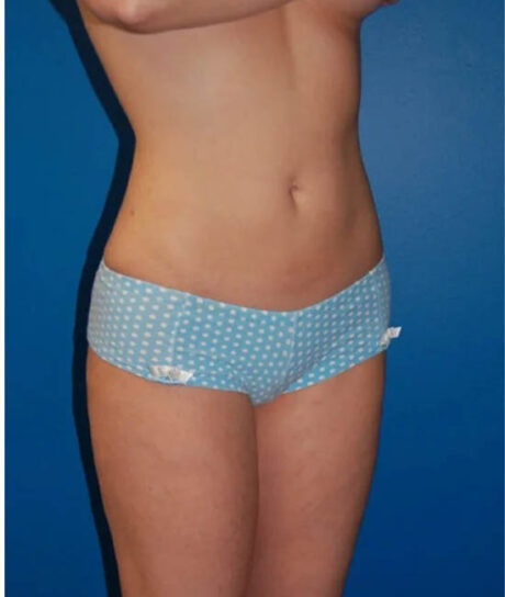 Liposuction case #4764