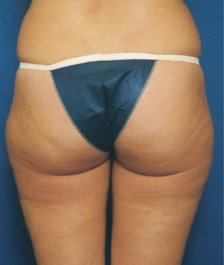 Liposuction case #4771