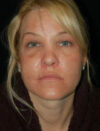 Facial Fat Grafting case #4522