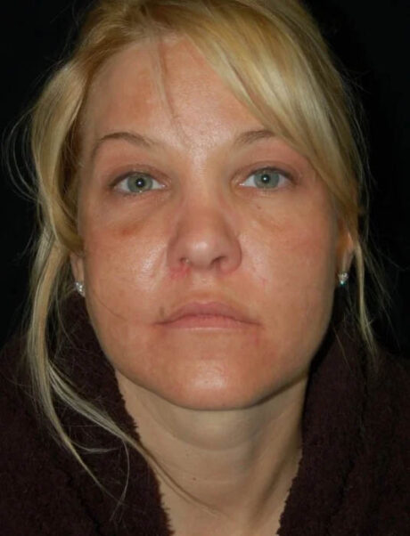 Facial Fat Grafting case #4522