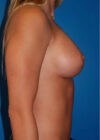 Breast Augmentation case #3729