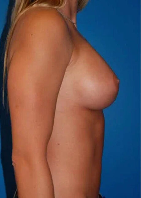Breast Augmentation case #3729