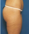 Liposuction case #4771