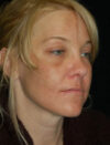 Facial Fat Grafting case #4522