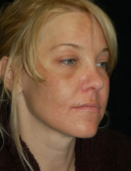 Facial Fat Grafting case #4522