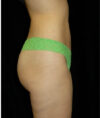 Liposuction case #4771