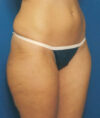 Liposuction case #4771