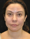 Facial Fat Grafting case #4605