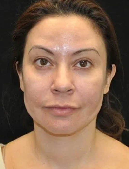 Facial Fat Grafting case #4605
