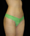 Liposuction case #4771