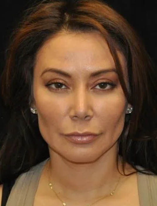 Facial Fat Grafting case #4605