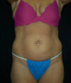 Liposuction case #4778