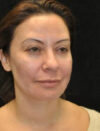 Facial Fat Grafting case #4605