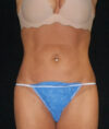 Liposuction case #4778