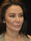 Facial Fat Grafting case #4605